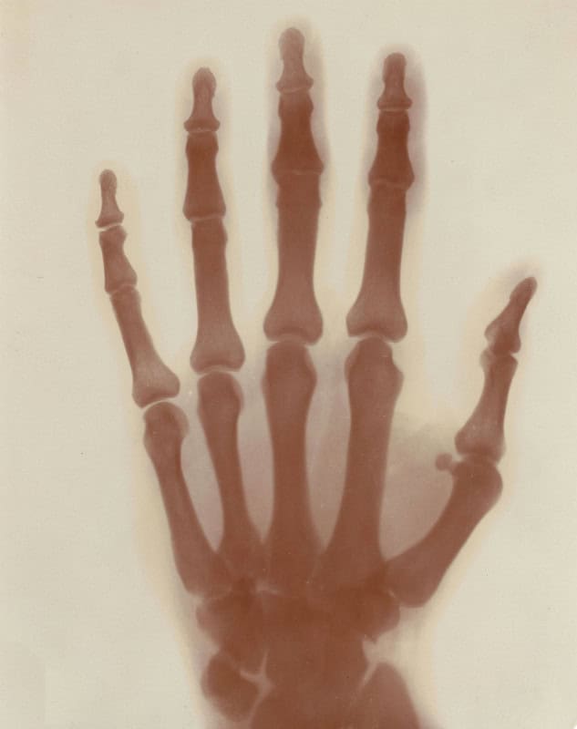 X-ray shadowgraph of Nikola Tesla's left hand made in his laboratory around 1896, showing the bones of the fingers and palm